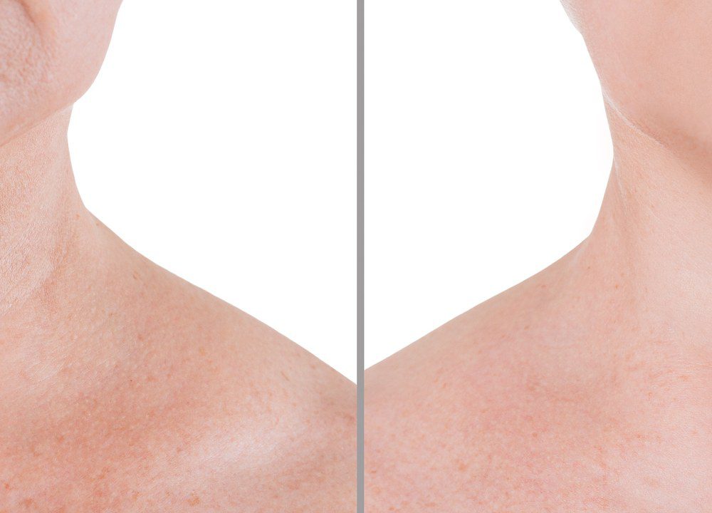 Neck Lifts