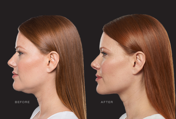 Eliminate Double Chin with KYBELLA®