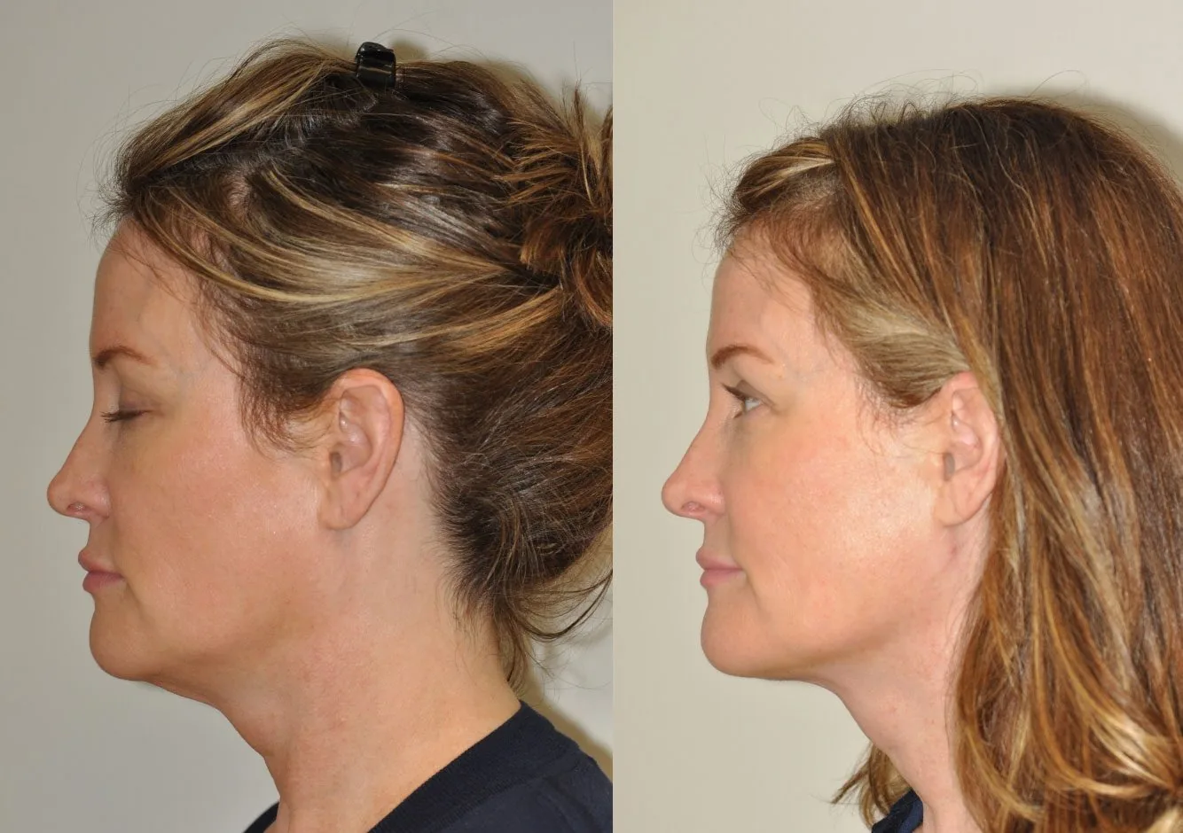 facetite example facetite example