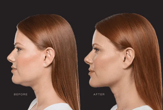 Kybella treatment effectively targets and reduces double chin