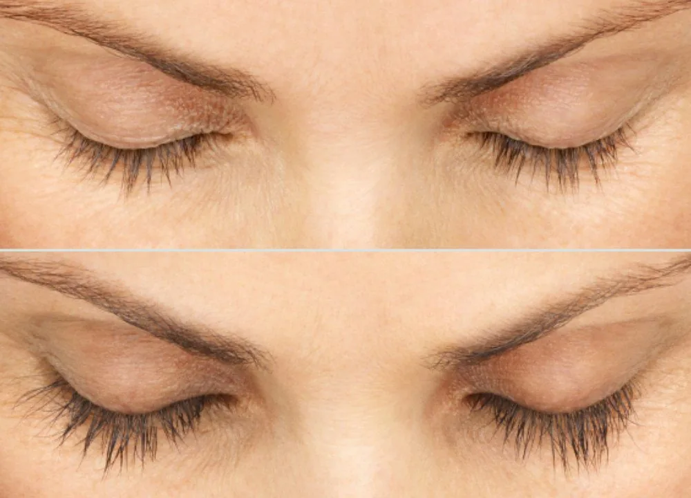 Latisse treatment ensuring longer and fuller eyelashes